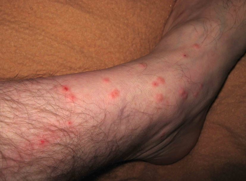 Top 10 Gnat Bites Pictures Explained! Pest Professional Services