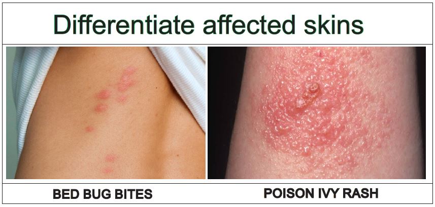 Bed Bug Bite Poison Ivy Rash VS In 6 Points Explained Pest Bed Bug Bite Poison Ivy Rash VS In 6 Points Explained Pest