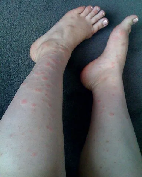Top 6 Pictures of Chigger Bites on Legs!