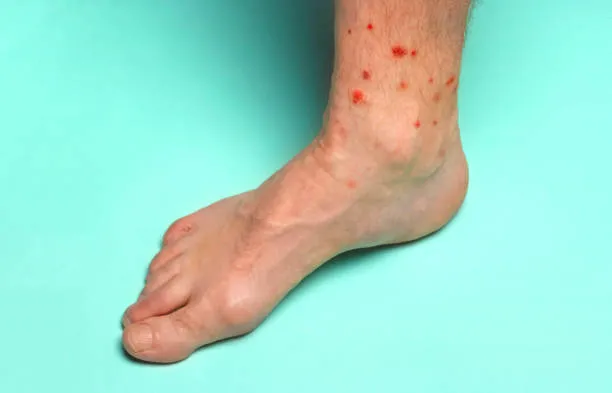 Top 5 Mosquito Bite vs Bed Bug Bite