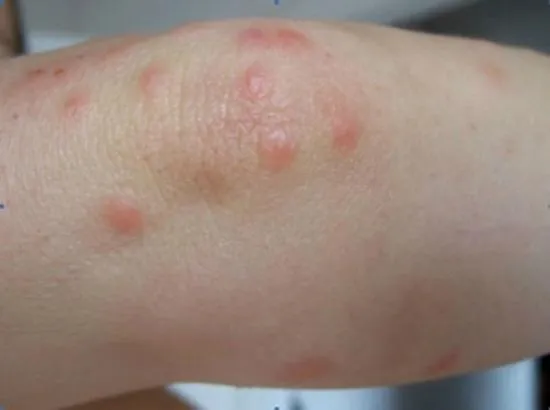 Do Bed Bugs Bites on Legs?