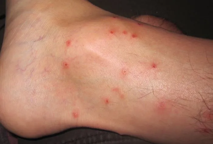 vWhat Does Chigger Bites Look Like on Human Skin?