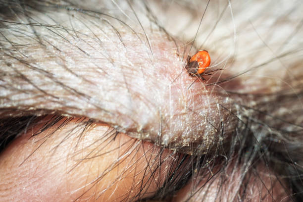 Chiggers in Hair