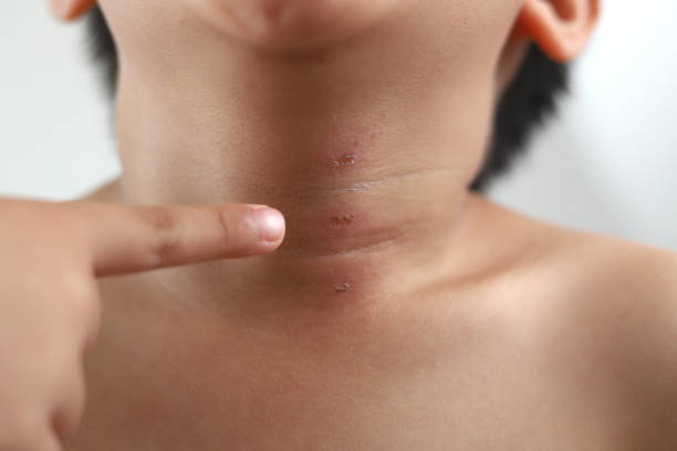 Do Chiggers Lay Eggs in Your Skin?