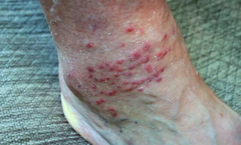 Can Chiggers Spread from Person to Person?