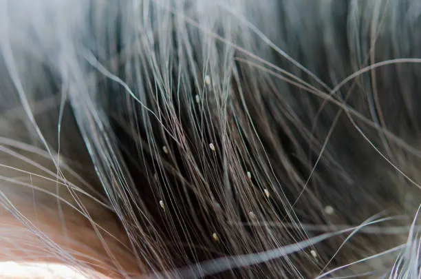 How to Remove Lice Eggs from Hair Permanently at Home?