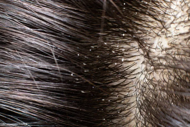 What Do Lice Eggs Look Like Up Close?