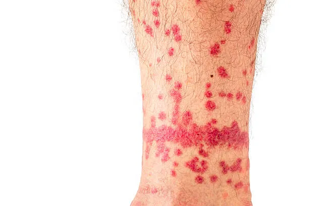 How to Stop Fleas from Biting You?